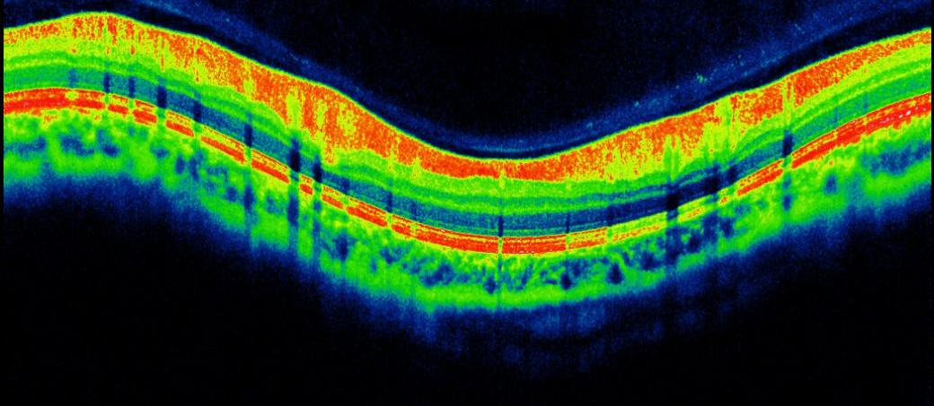 Scan of the retina from the OCT machine.