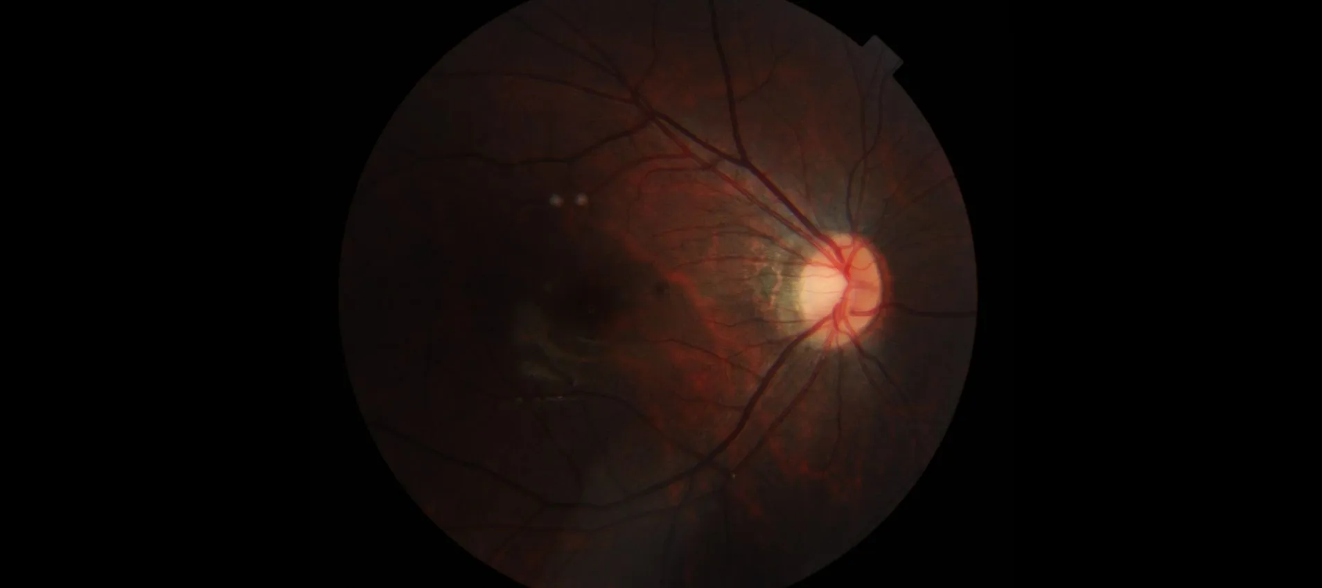 High myope fundus photo